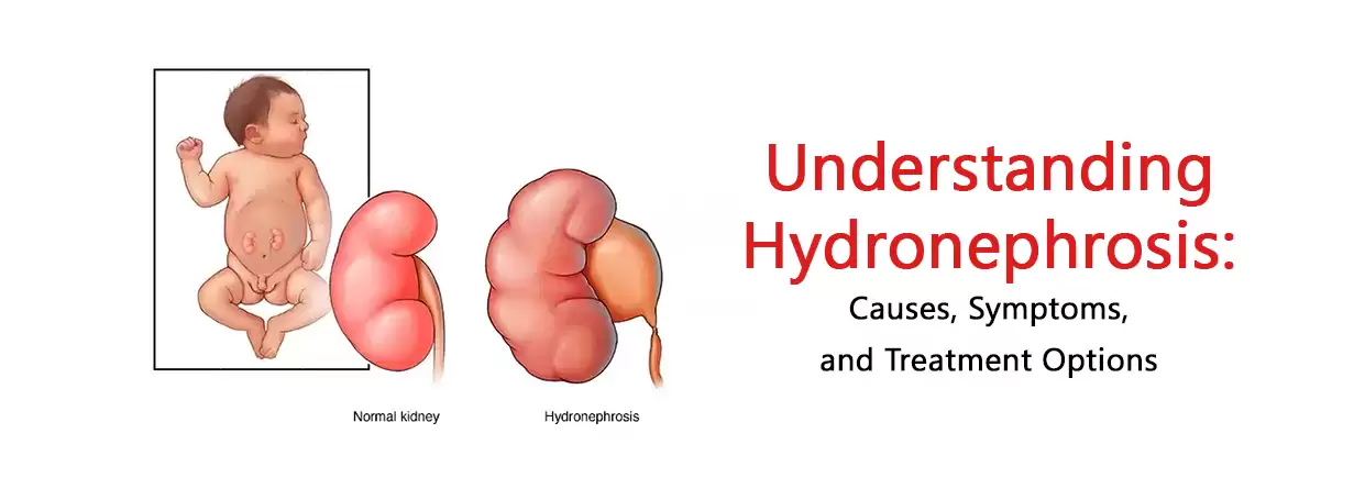 Understanding Hydronephrosis: Causes, Symptoms, and Treatment Options